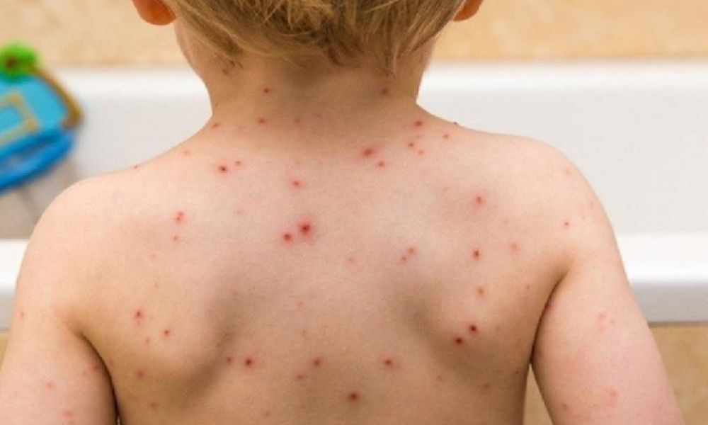 Male boginje mogu biti fatalne po dete - kako prepoznati prve simptome