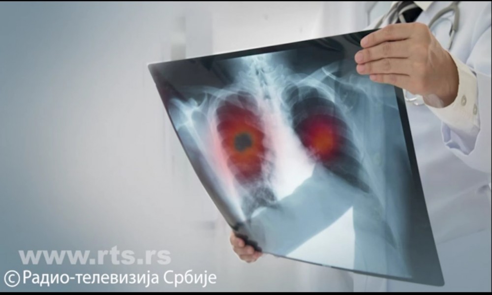 Rak pluća svaka dva sata odnese život - prijavite se za skrining